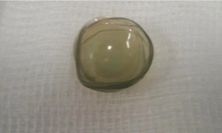 A mass of 17 contact lenses were removed from the eye of a 67-year-old.