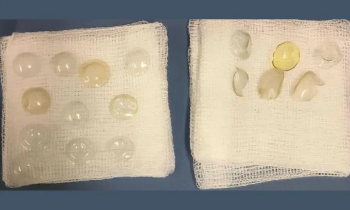 When they pulled the mass apart it was made up of 17 contact lenses.