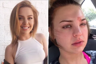 Woman’s warning after pimple becomes sight-threatening infection