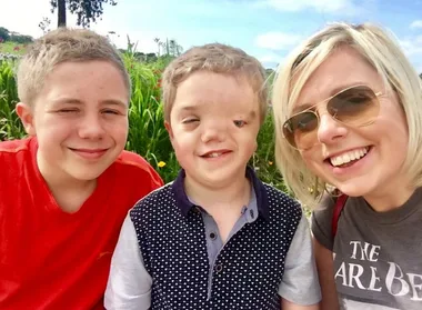 Instagram pulls photo after disabled boy’s facial deformity is reported