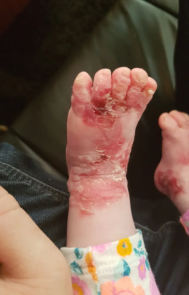 Baby skin condition