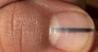Dark stripe on woman’s nail turns out to be deadly disease