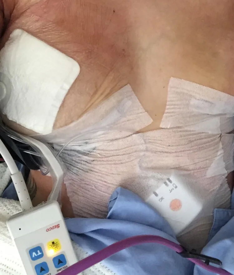 boob job stitches