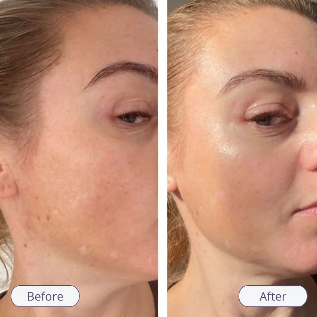 Retinol results