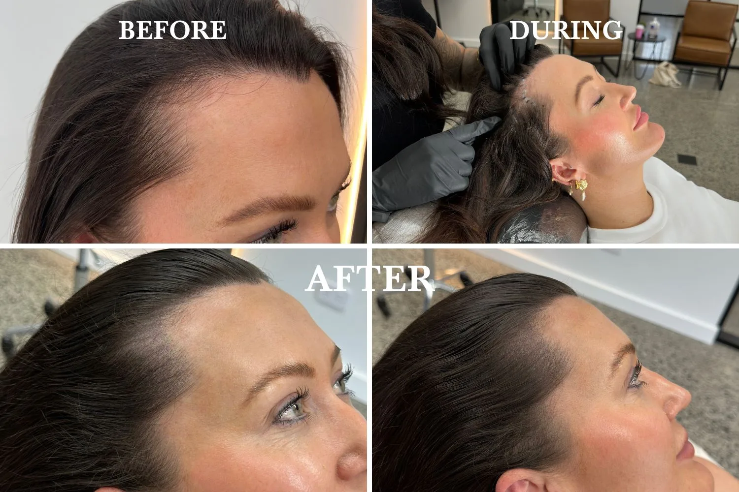 elise wilson before during after scalp micropigmentation treatment
