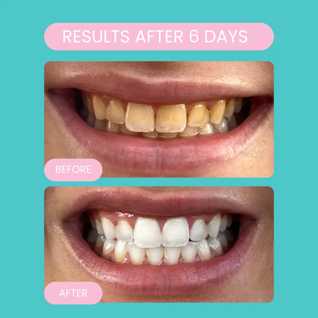 Fantastic results are within days of using the Smilie at home whitening kit.