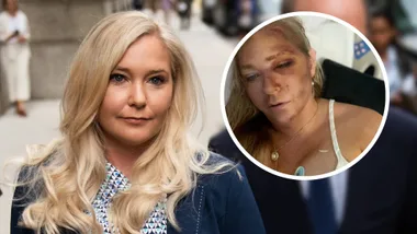 Virginia Giuffre posted a photo of herself all bruised after an accident with a bus.