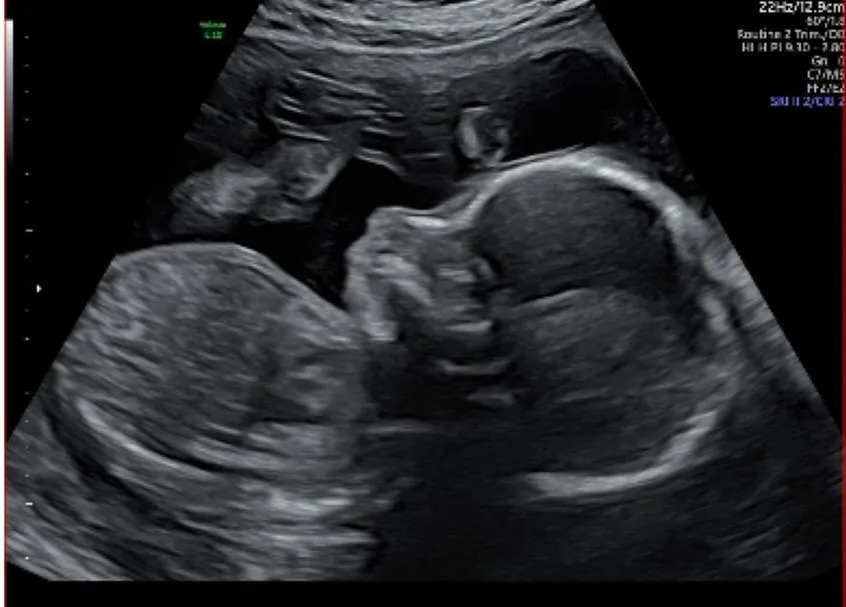 a sonogram of james tobin and farrah tobin's baby