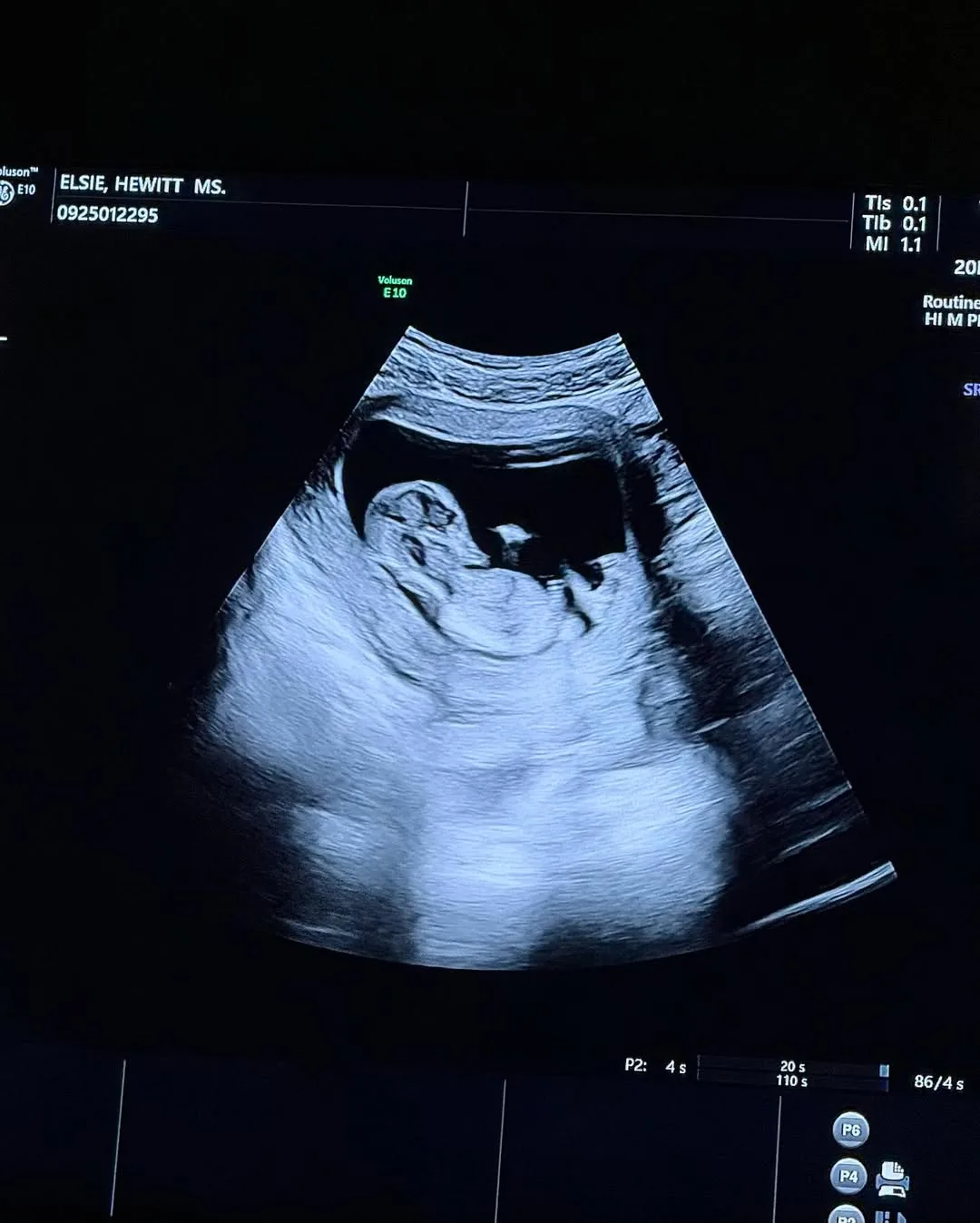 a sonogram of pete davidson baby with elsie hewitt