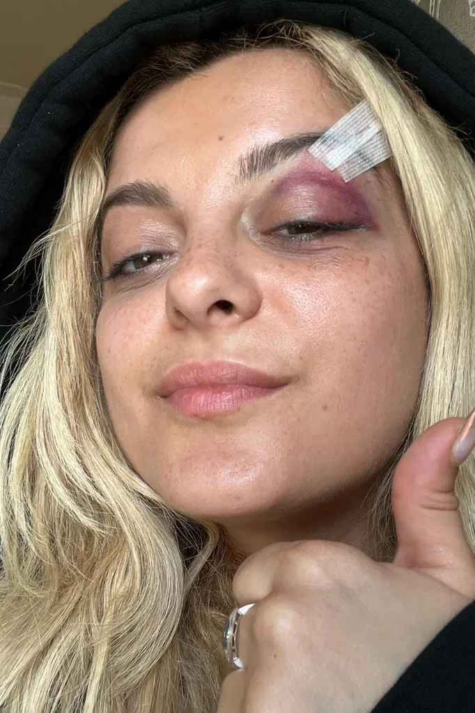 bebe rexha looking at the camera with a thumbs up in a selfie displaying her bruising and stitches near her eyebrow