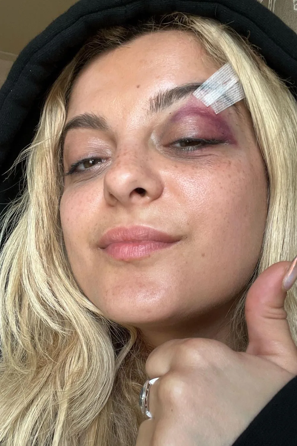 bebe rexha looking at the camera with a thumbs up in a selfie displaying her bruising and stitches near her eyebrow