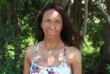 Turia Pitt shows off her amazing post-baby body in new picture