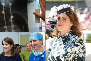 Princess Eugenie shared X-Rays from her childhood scoliosis surgery