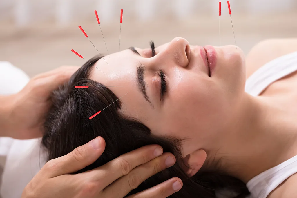 facial acupuncture