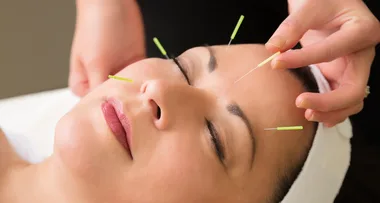 Everything you need to know about cosmetic acupuncture