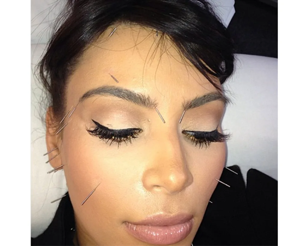 face acupuncture