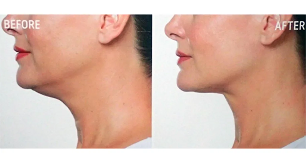 double chin injections