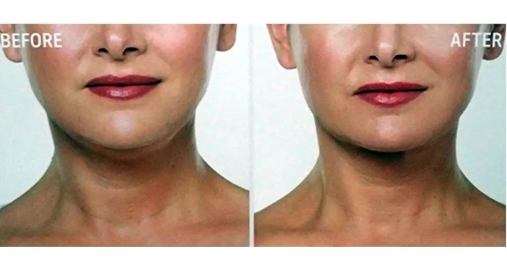 double chin injections