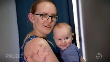 Mum suffers severe bruises after protecting baby from hail storm: ‘I covered her with my body’