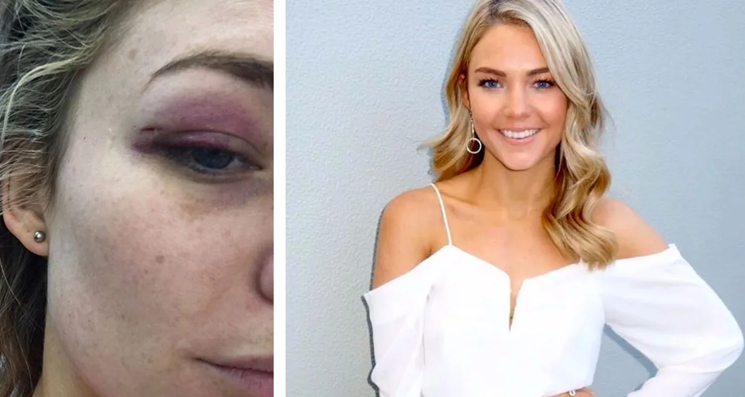 Sam Frost has a black eye. Here’s why