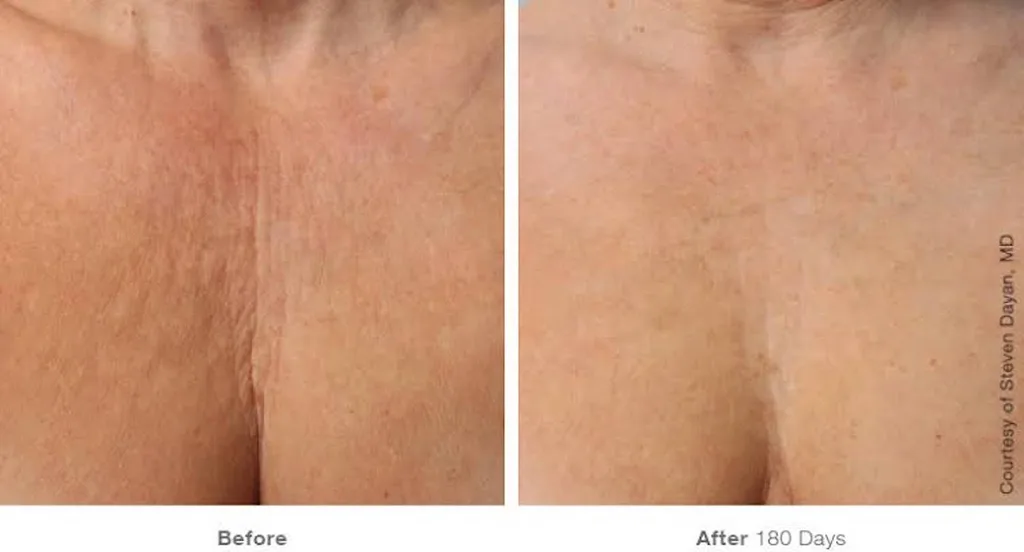 Before and after laser treatment