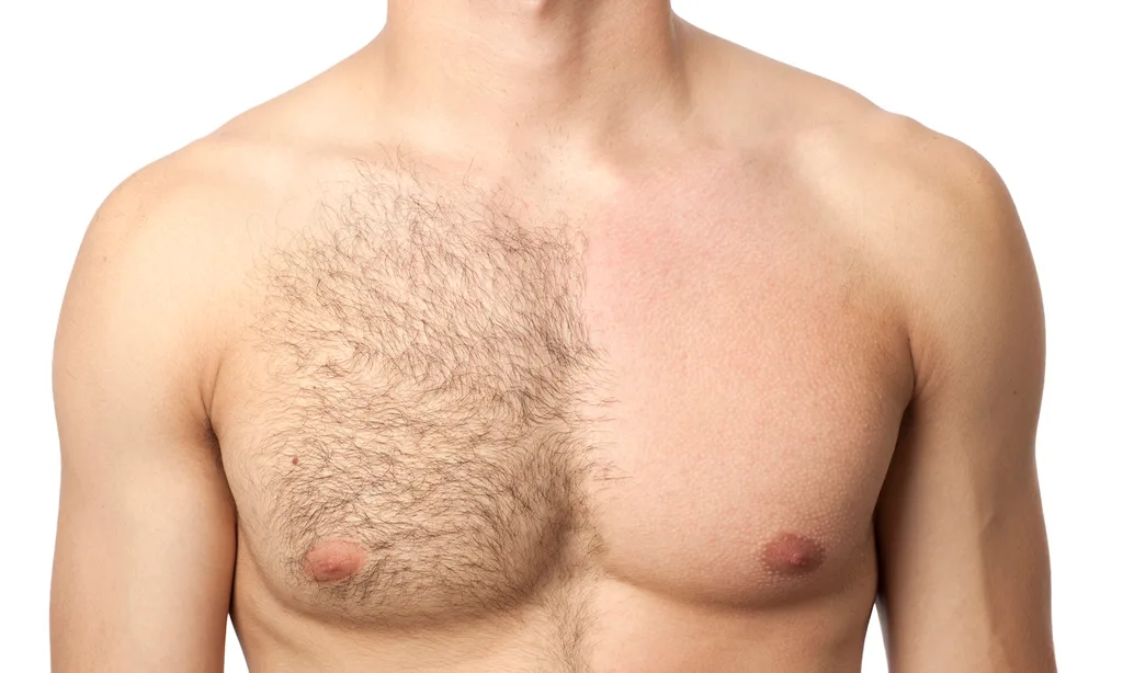 Yep, men can get laser hair removal too