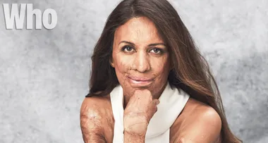 WHO’s Most Beautiful: Turia Pitt reveals she lost pride in her appearance