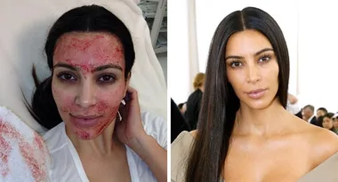 Doctors issue terrifying warning about ‘vampire facials’ after two people diagnosed with HIV