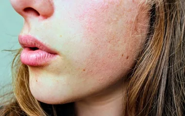 Best Toner For Dry Skin: Witch Hazel, Pixi Glow And More