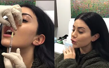 MAFS’ Martha Kalifatidis fixes her “botched” lips after denying ever having filler