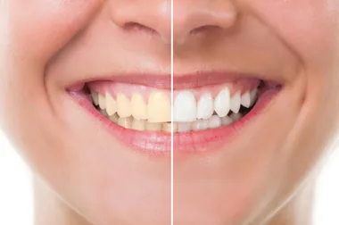 5 Teeth Whitening Kits to Achieve Pearly Whites At Home