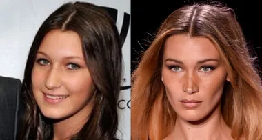 Bella Hadid plastic surgery: Before and after