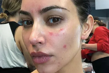 Kim Kardashian is having major problems with her psoriasis