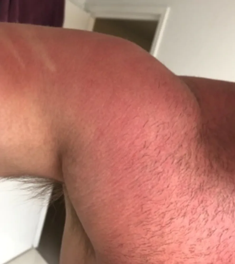 sunburnt