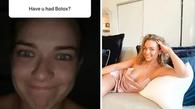 Abbie Chatfield says she’s never had botox