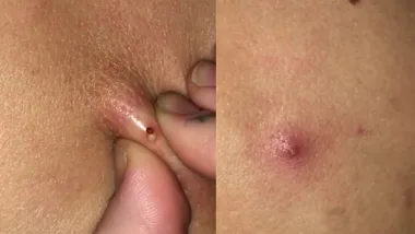 Miley pops Cody’s pimple