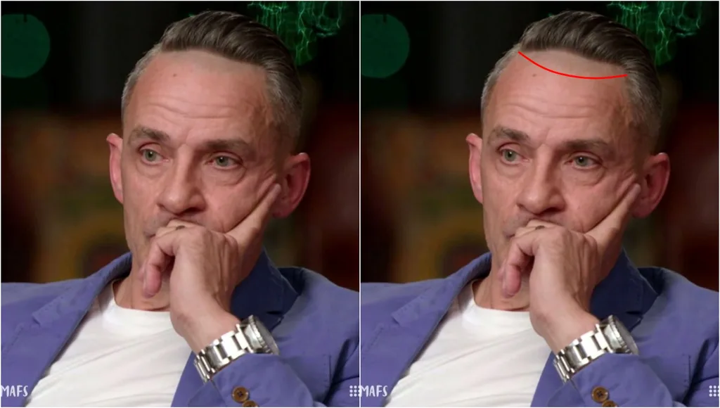 Steve Burley shaves his hairline