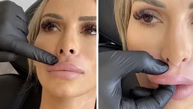 MAFS’ Stacey Hampton gets lip filler dissolved
