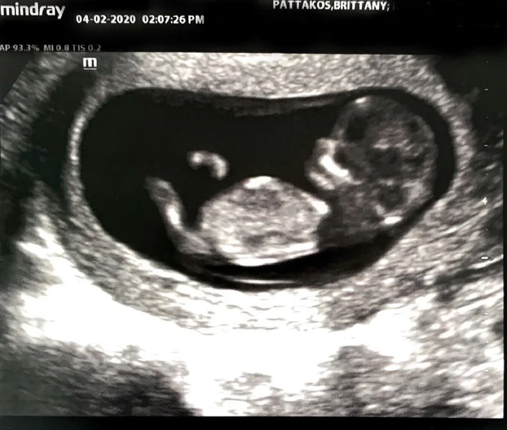 sonogrambothcedbaby