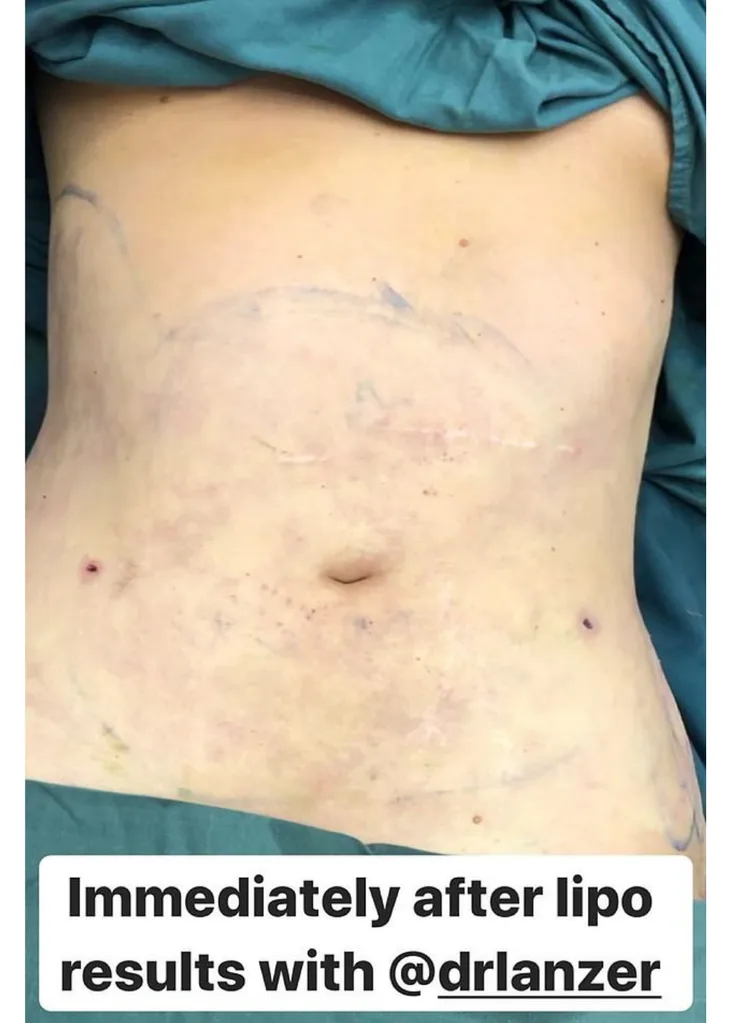 lipo