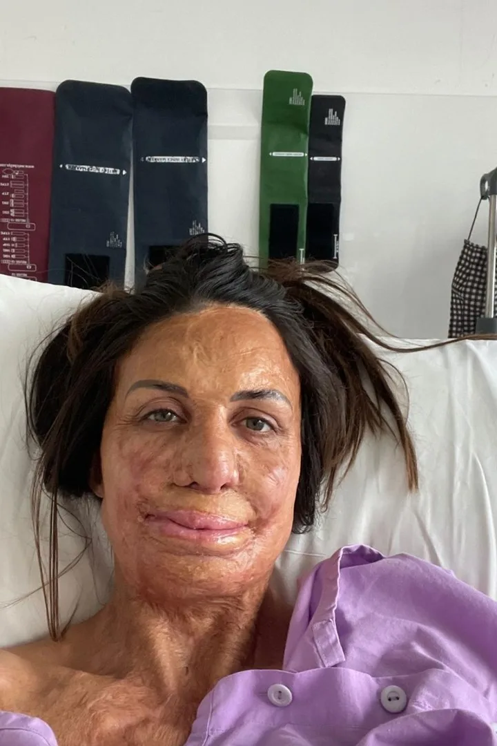 turia pitt hospital