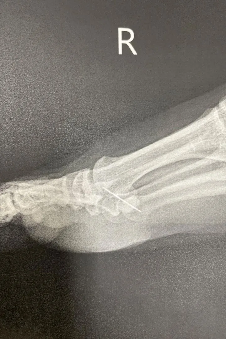 turia pitt foot injury