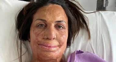 Turia Pitt left in “unbearable” pain after freak accident