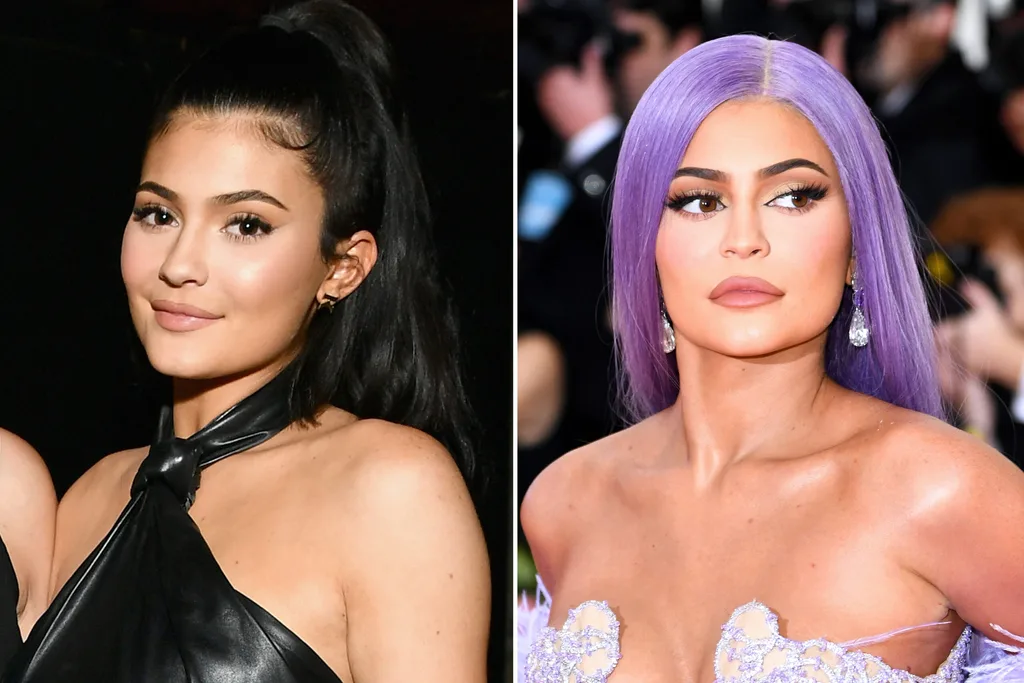 kylie-jenner-lips-before-after