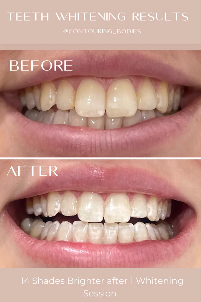 teeth-after