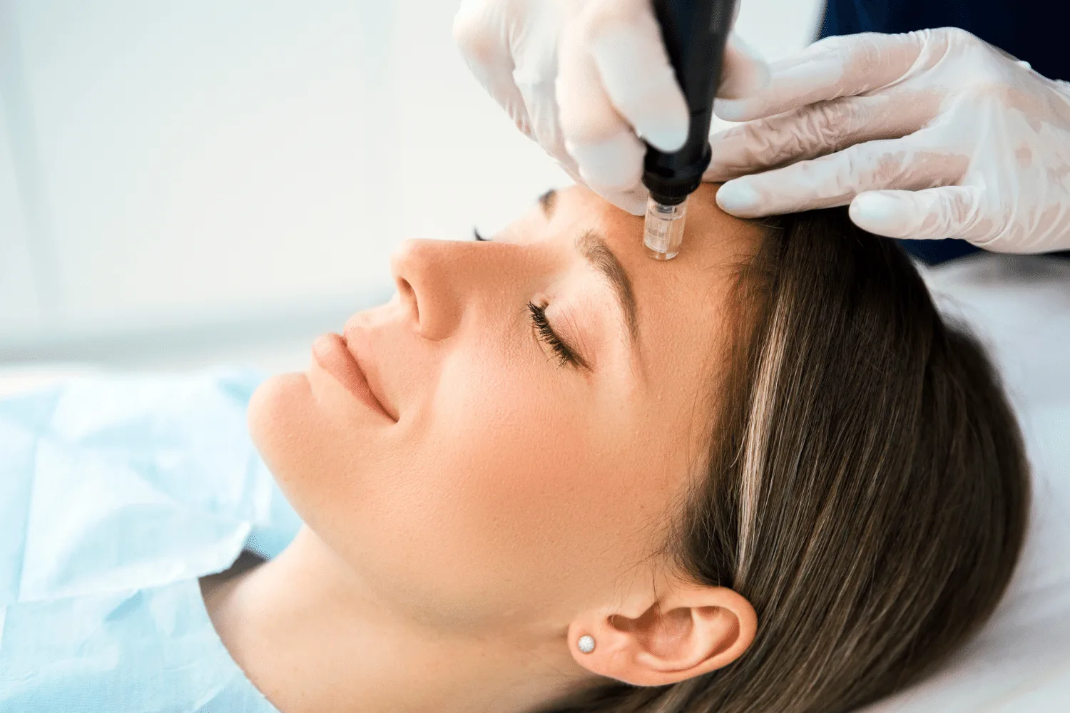Skin Needling