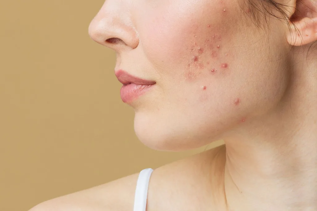 hormonal-acne