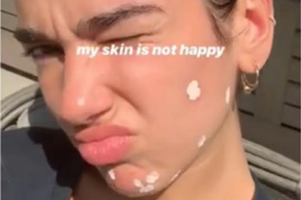 dua-lipa-my-skin-is-not-happy