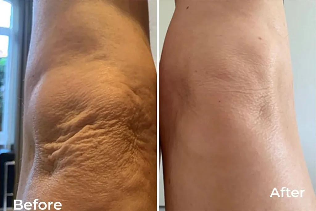 Lyma-before-after