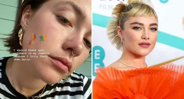 The $18 pimple patches Florence Pugh swears by
